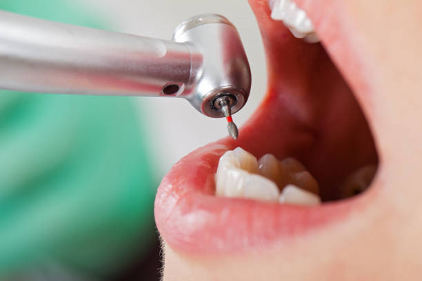 Urgent Tooth Repair in CA